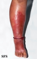 erysipelas