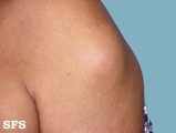 lipoma