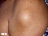 lipoma