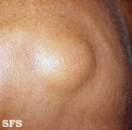lipoma