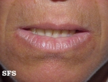 actinic cheilitis