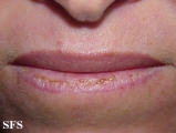 actinic cheilitis