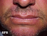 actinic cheilitis
