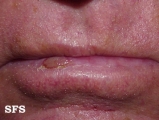 actinic cheilitis