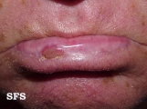 actinic cheilitis