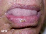 actinic cheilitis