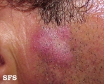 lupus erythematosus chronicus discoides