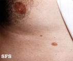 nipples supernumerary