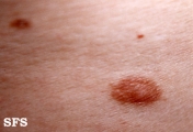 nipples supernumerary
