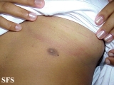 nipples supernumerary