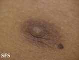 nipples supernumerary