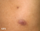 nipples supernumerary
