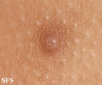 nipples supernumerary
