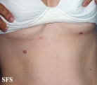 nipples supernumerary