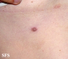 nipples supernumerary