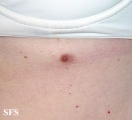 nipples supernumerary