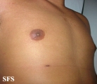 nipples supernumerary