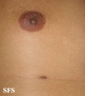 nipples supernumerary