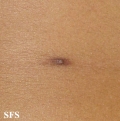 nipples supernumerary
