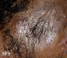 syringolymphoid hyperplasia with alopecia