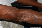 tinea corporis
