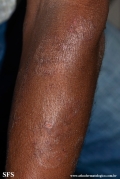 tinea corporis