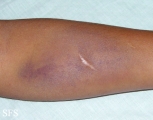 painful bruising syndrome