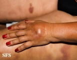 painful bruising syndrome