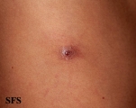 myiasis-furuncular myiais