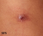 myiasis-furuncular myiais
