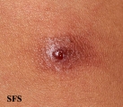 myiasis-furuncular myiais