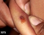 myiasis-furuncular myiais