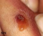 myiasis-furuncular myiais
