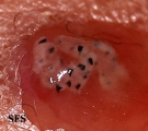 myiasis-furuncular myiais
