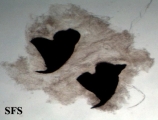 myiasis-furuncular myiais