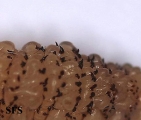 myiasis-furuncular myiais