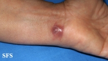 myiasis-furuncular myiais