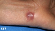 myiasis-furuncular myiais