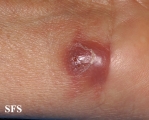 myiasis-furuncular myiais