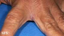 myiasis-furuncular myiais