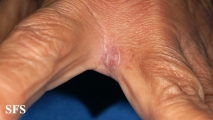 myiasis-furuncular myiais