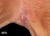 myiasis-furuncular myiais