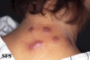 myiasis-furuncular myiais