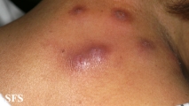 myiasis-furuncular myiais