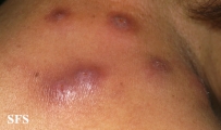 myiasis-furuncular myiais