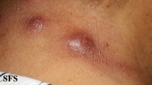 myiasis-furuncular myiais