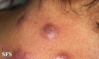 myiasis-furuncular myiais