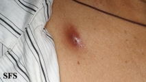 myiasis-furuncular myiais