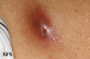 myiasis-furuncular myiais