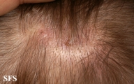 myiasis-furuncular myiais